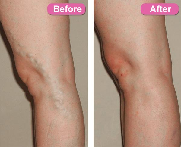 Varicose Veins Treatment Cream - MakenShop