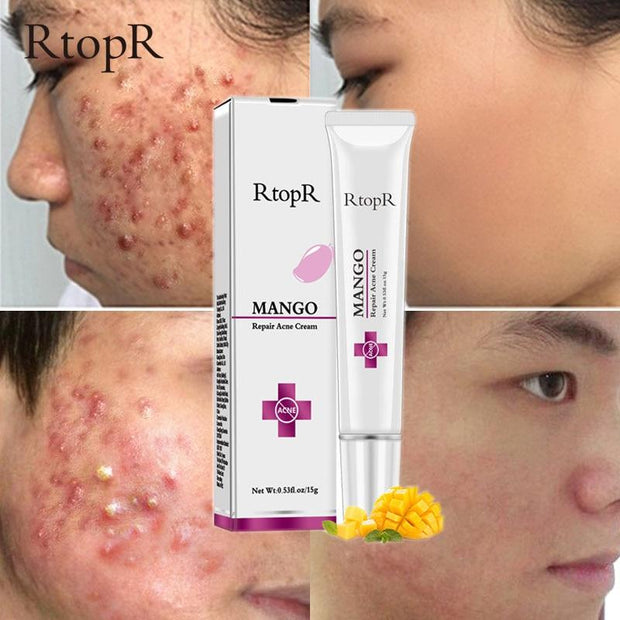 Acne Treatment Blackhead Repair Whitening Moisturizer - MakenShop