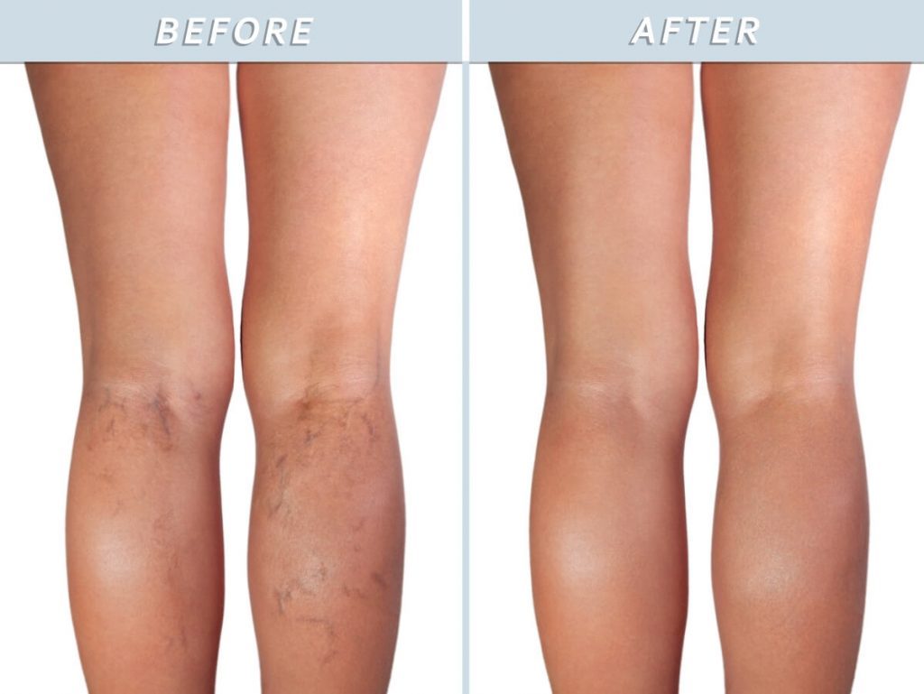 Varicose Veins Treatment Cream - MakenShop